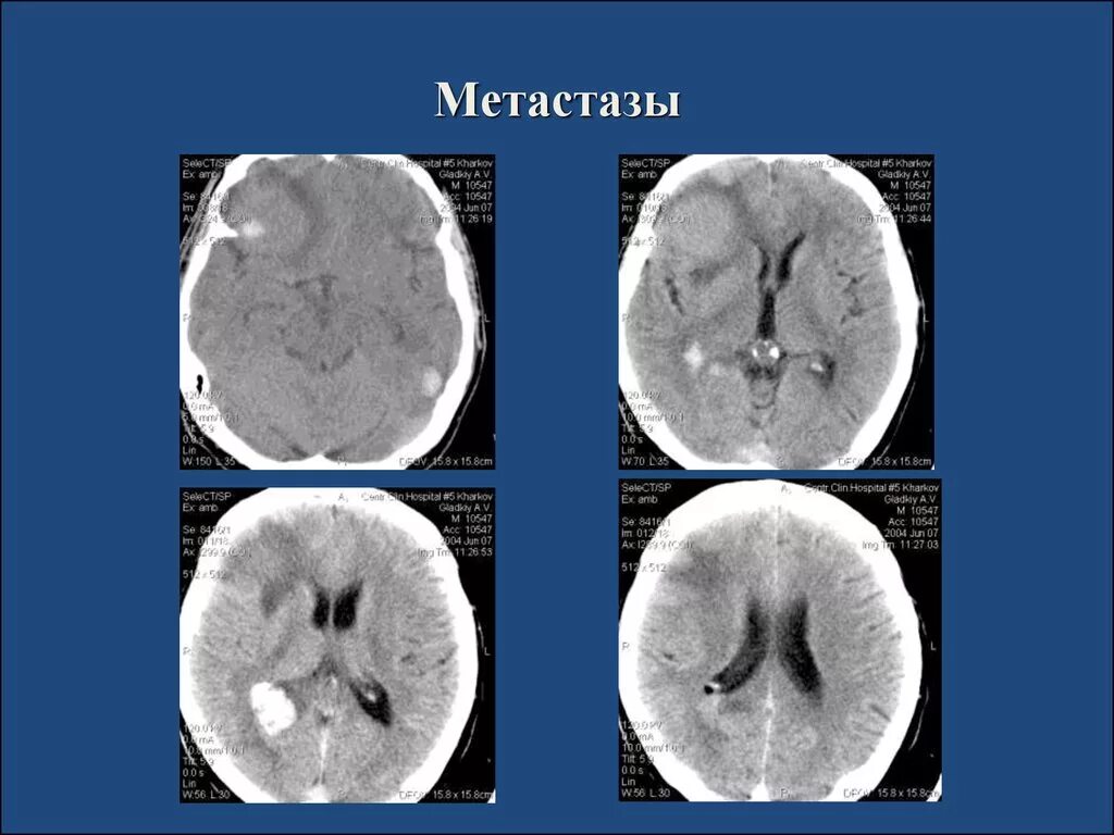 Лечение метастазов мозга. Меланома на кт головного мозга. Метастазы головного мозга кт.