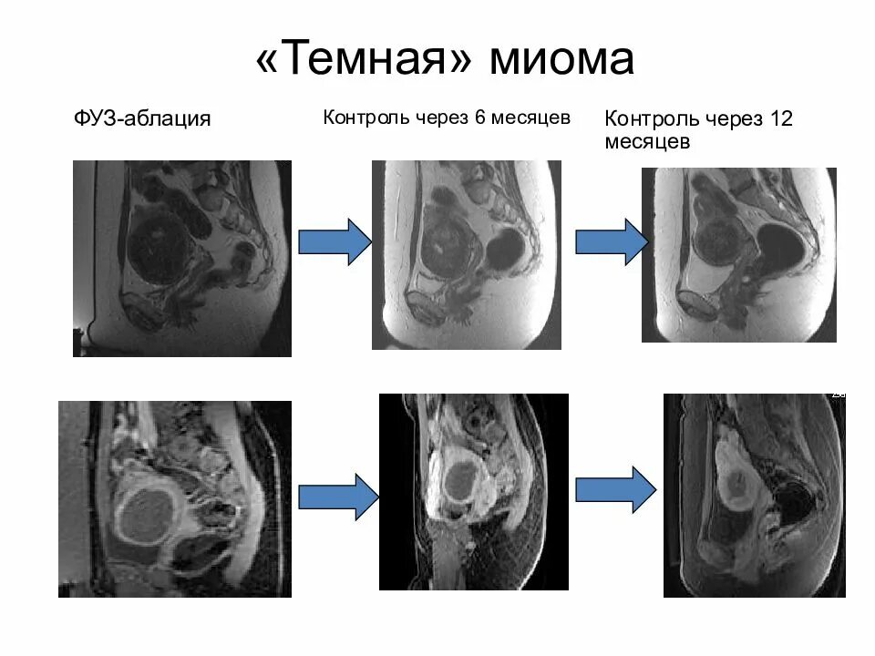 Абляция миомы
