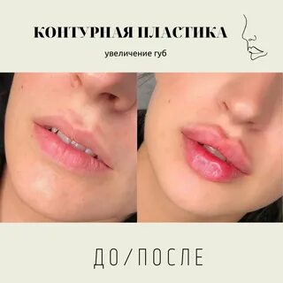 Можно ли увеличить губы