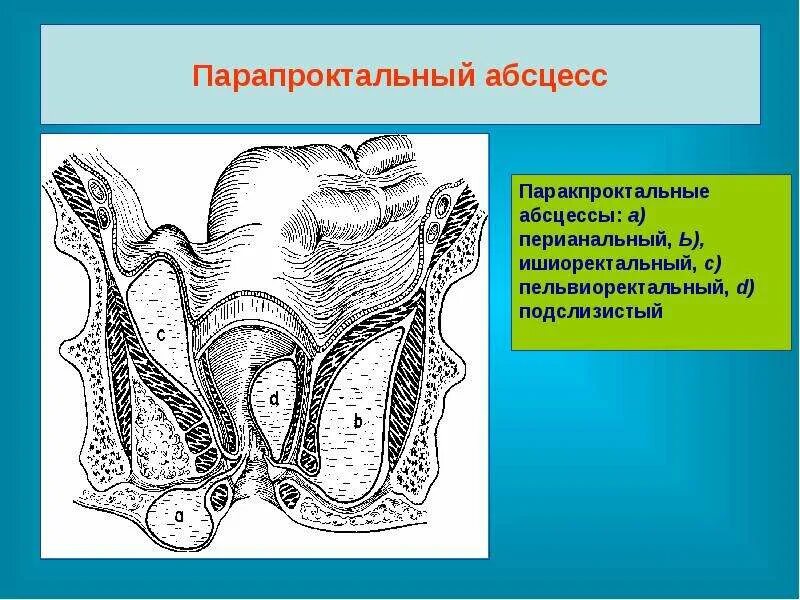 Перианальные складки где. Перианальные складки где. Хронический параректальный свищ. Острый гнойный ишиоректальный парапроктит. Соскоб с перианальных складок на энтеробиоз.