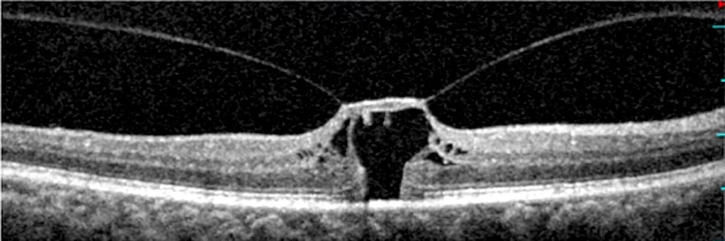 Макулярный разрыв после операции. Ламеллярный макулярный разрыв сетчатки. Ламеллярный разрыв макулы. Ламеллярный макулярный разрыв окт. Несквозной макулярный разрыв.