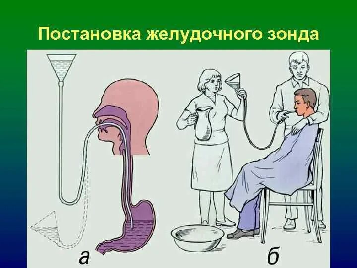 Кормление тяжелобольного через рот. Промывание желудка зондом алгоритм. Зондовое промывание желудка. Постановка желудочного зонда. Кормление через желудочный зонд.