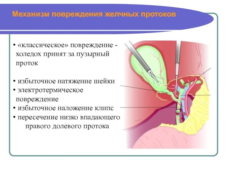 Протоки печени холедох. Желчный проток холедох. Холедох пузырный проток. Где находится холедох у человека. Холедох печени норма