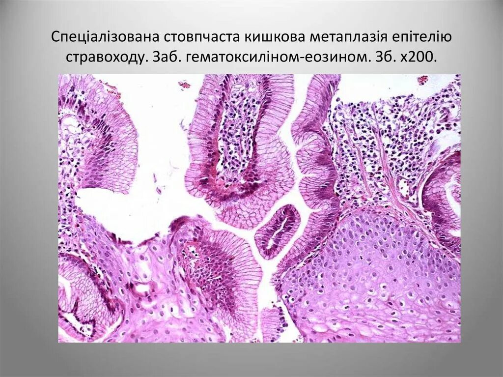 Кишечная метаплазия патанатомия. Толстокишечная метаплазия гистология. Кишечная метаплазия микропрепарат. Пищевод Барретта метаплазия эпителия.