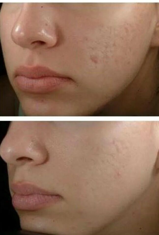 Как убрать ямки после. Угревая сыпь, акне, постакне,. Атрофический нормотрофический гипертрофический рубец. Как убрать ямки после. Контурная пластика носослёзной борозды.