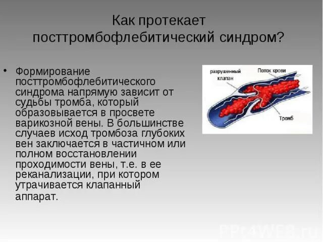 Посттромбофлебитическом синдроме. Посттромбофлебитическая болезнь нижних конечностей. Тромбоз артерии мкб 10