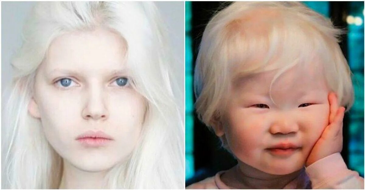 11-летняя девочка-альбинос с гетерохромией из Чечни поражает своей волшебной кра