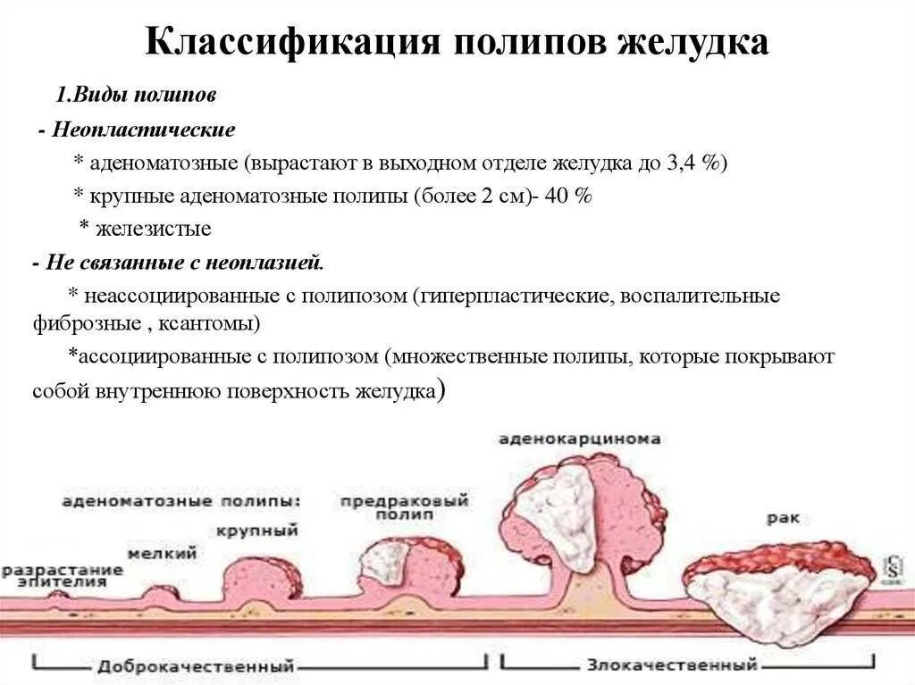 0 1 тип полипа. Полипы толстой кишки классификация по типам видам. классификация полипов желудка.