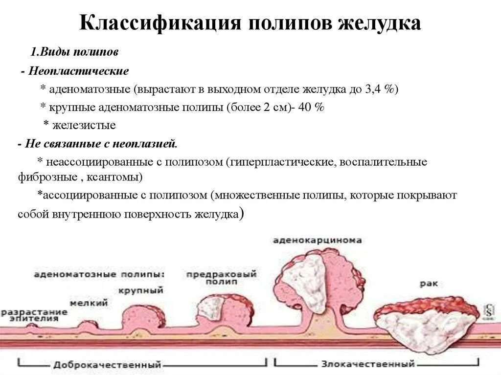 Можно ли есть кишки. Неопластические полипы желудка. Типы полипов в кишечнике классификация. Классификация полипов желудка эндоскопическая. Классификация полипов желу.