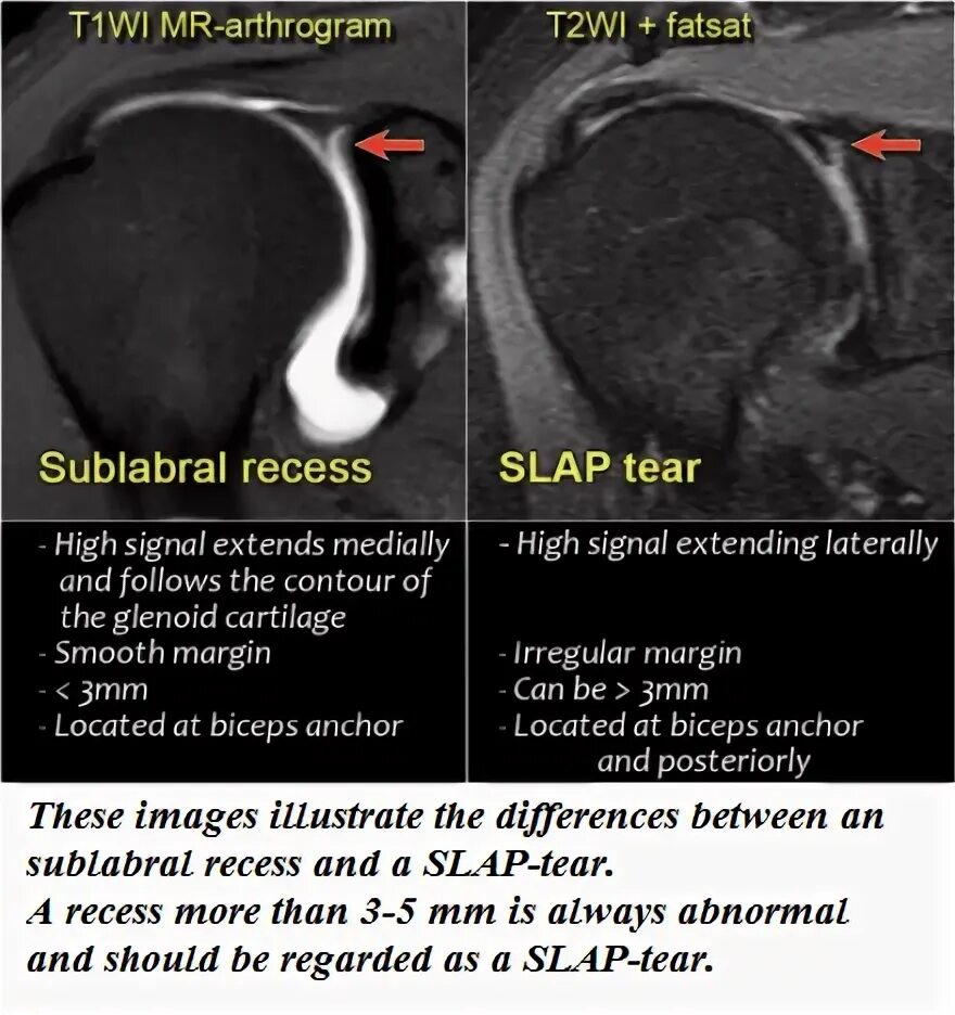 Slap синдром плечевого сустава мрт. Разрыв гленоида плечевого сустава на мрт. Slap повреждение плечевого сустава на мрт.