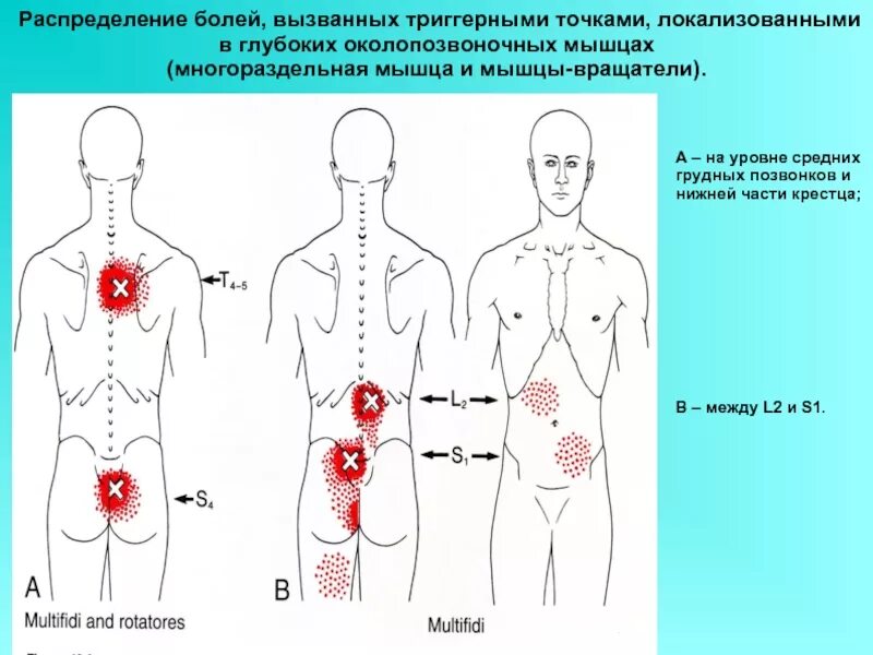 Точки болезненности. Триггерные точки грудного отдела позвоночника. Триггерные точки на спине грудной отдел. Триггерные точки крестца. Триггерные точки на спине схема.