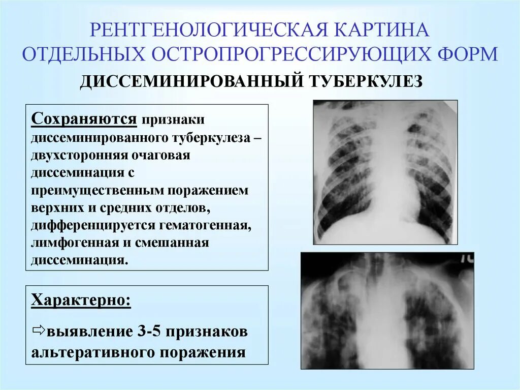 Подострый диссеминированный туберкулез рентген. Рентгенологические синдромы диссеминированного туберкулеза. Острый диссеминированный туберкулез рентген. Клинические синдромы диссеминированного туберкулеза.