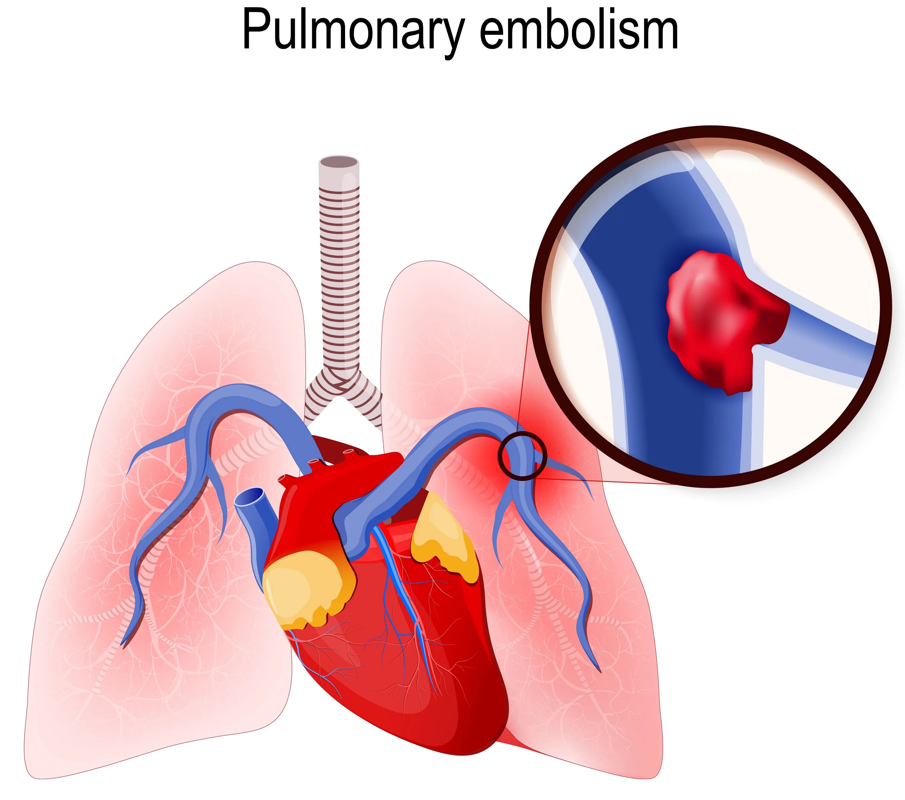 Тромбоэмболия легочной артерии. Тромбоэмболия лёгочной артерии сердце. Тромбоэмболия легочной артерии (Тэла).