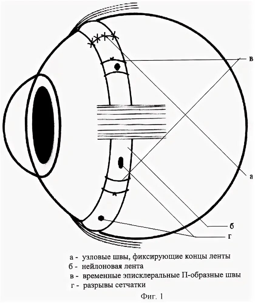 Пломбирование сетчатки глаза. Отслойка сетчатки экстрасклеральное пломбирование. локальное эписклеральное пломбирование сетчатки глаза. экстрасклеральное пломбирование сетчатки глаза. склеральное пломбирование сетчатки глаза.