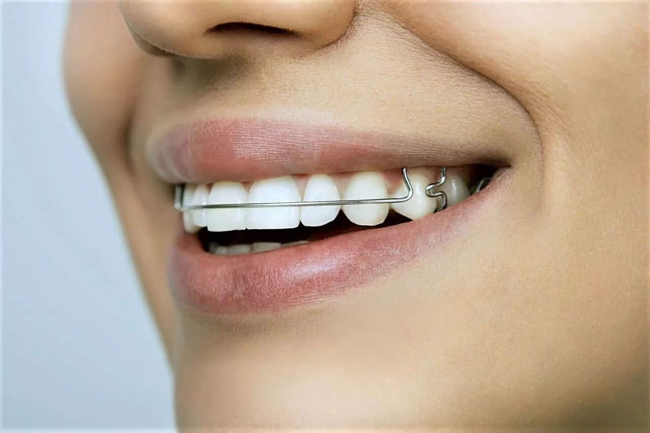 Ортодонтия что это. Скобы пластинки для зубов. Пластина для выпрямления зубов. Пластинки для зубов для выравнивания прикуса.