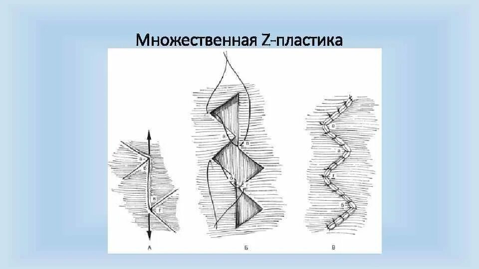 Методика лихтенштейна при паховой грыже. Метод лексера при пупочных грыжах. Пластика пахового канала бассини. Типы лоскутов на питающей ножке. Пластика по другому.