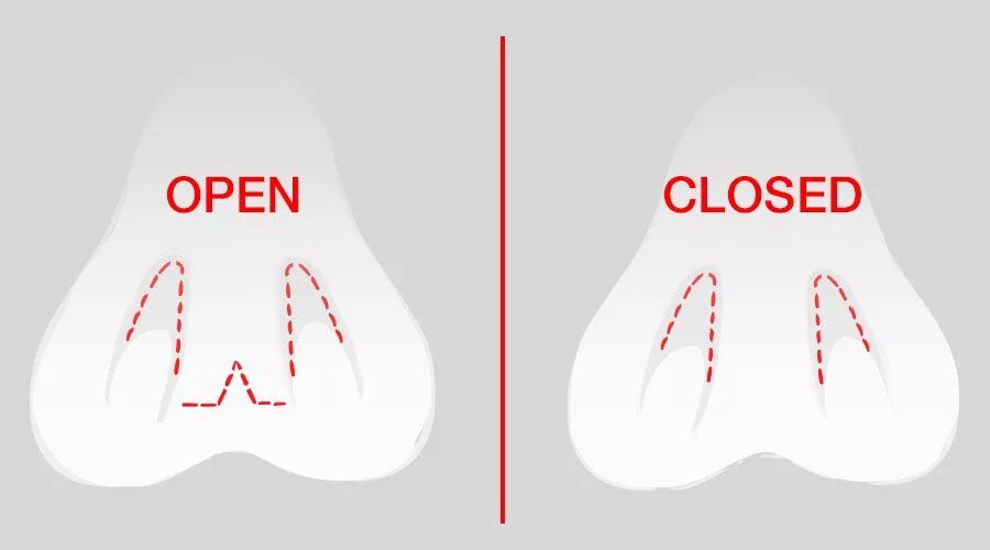 Open approach. Open closed. open nose surgery.