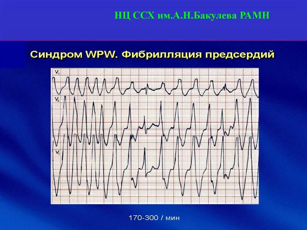 Синдром преждевременного возбуждения желудочков. Парциальный синдром предвозбуждения желудочков на экг. экг при синдромах предвозбуждения желудочков.. феномен предвозбуждения желудочков. преждевременное возбуждение желудочков на экг.
