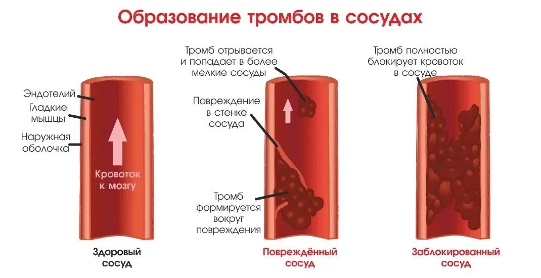 Тромб причины образования. Образование тромбов в артериях. Тромбоз кровотечение