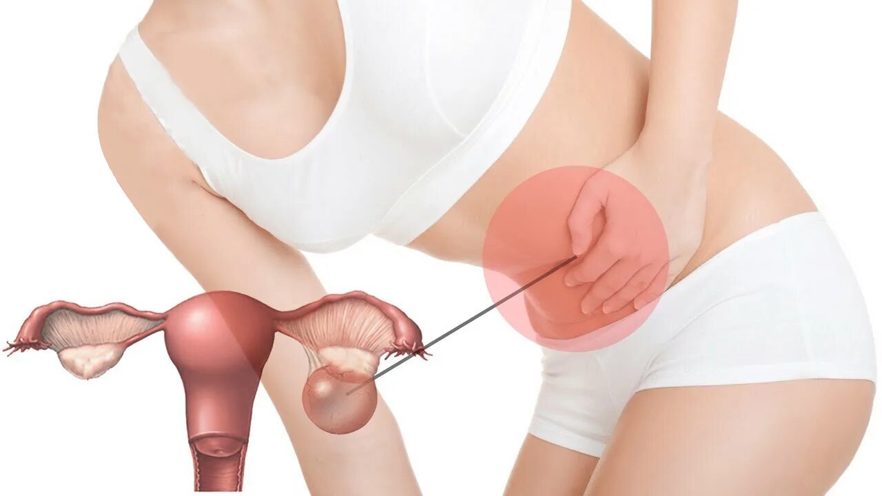 Дискомфорт в яичниках. Pcos symptoms. Дискомфорт в яичниках. Боль яичника отдает в спину. Боль в правом яичнике при овуляции.