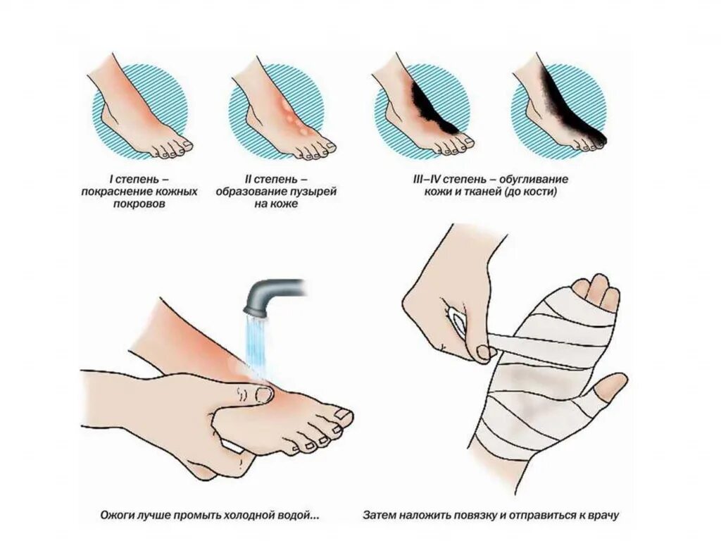 Термический ожог 1 степени первая помощь. Оказание первой помощи при термическом ожоге 1 степени. При термическом ожоге при оказании первой помощи необходимо. Порядок оказания первой помощи при термических ожогах второй степени. Оказание 1 доврачебной помощи при термических ожогах.