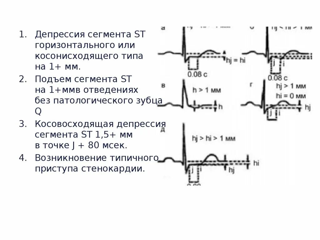 Эпизод депрессии st. Корытообразная депрессия сегмента St на ЭКГ. ЭКГ горизонтальная депрессия сегмента St. Депрессия сегмента St на ЭКГ В 1 отведении. Депрессия St в отведениях v6.