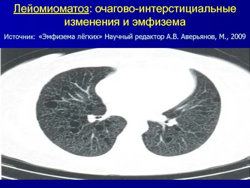 Неспецифическая интерстициальная пневмония кт. Интерстициальная пневмония на кт. Неспецифическая интерстициальная пневмония на кт легких. Интерстициальный отек легких кт. Наличие очаговых изменений