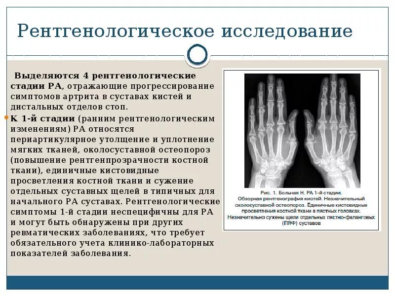 Ревматоидный артрит обследование. Ревматоидный артрит кисти рентген. Ревматоидный артрит кистей рук рентген. Ревматоидный артрит кисти рентген стадии. Ревматоидный артрит диагностика рентген.