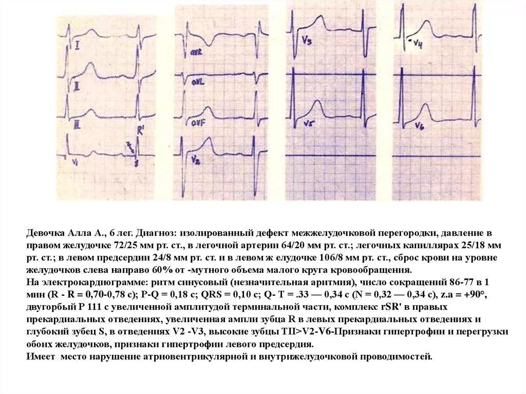 Дефект межпредсердной перегородки кардиограмма. Экг при гипертрофии левого правого желудочка. Гипертрофия правого желудочка на экг. Экг критерии инфаркта правого желудочка. Изменения миокарда правого желудочка.