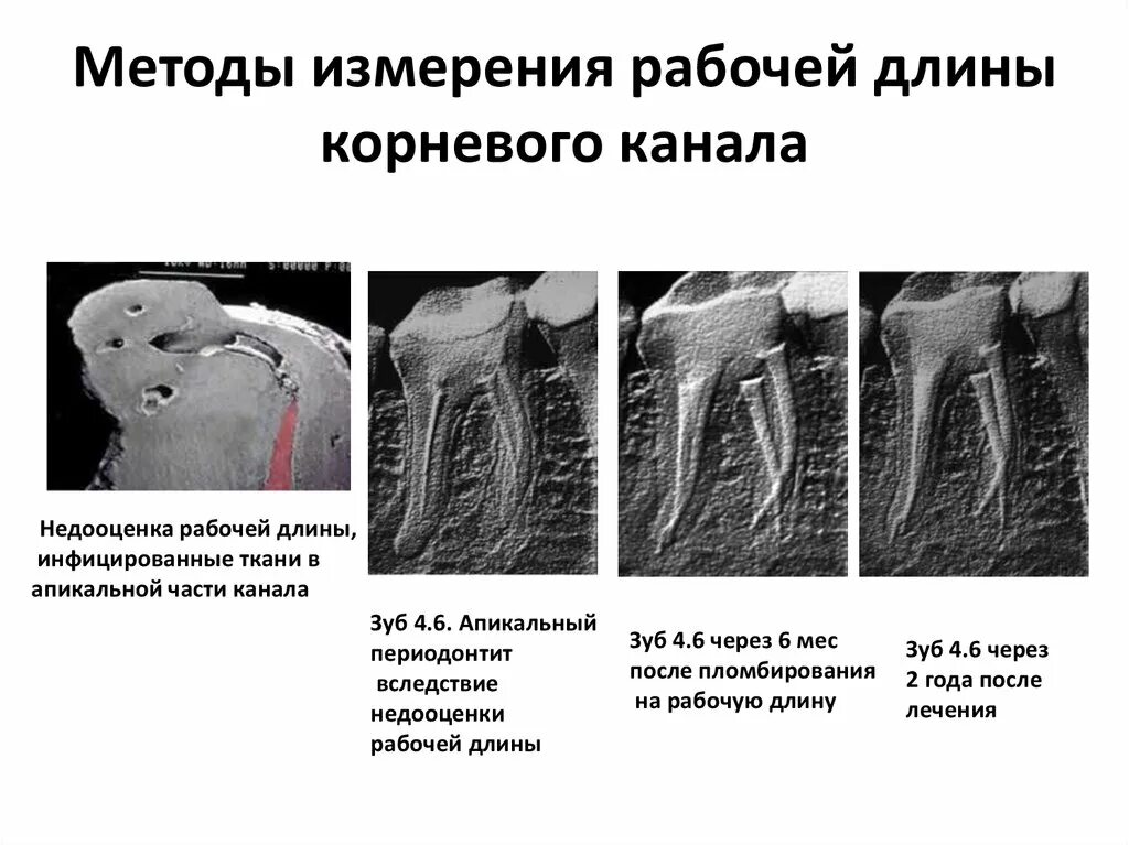 Определение корневых каналов. Анатомический метод определения рабочей длины корневого канала. Тактильный способ определения длины корневого канала. Методики определения рабочей длины корневого канала. Апикальная часть корневого канала.