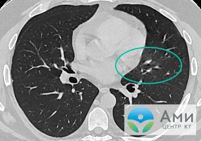 Легочный фиброз кт. Пневмофиброз на кт легких. Очаговый фиброз легких на кт. Линейный фиброз легкого кт.