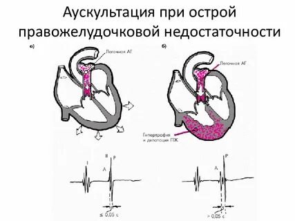Легочной тон