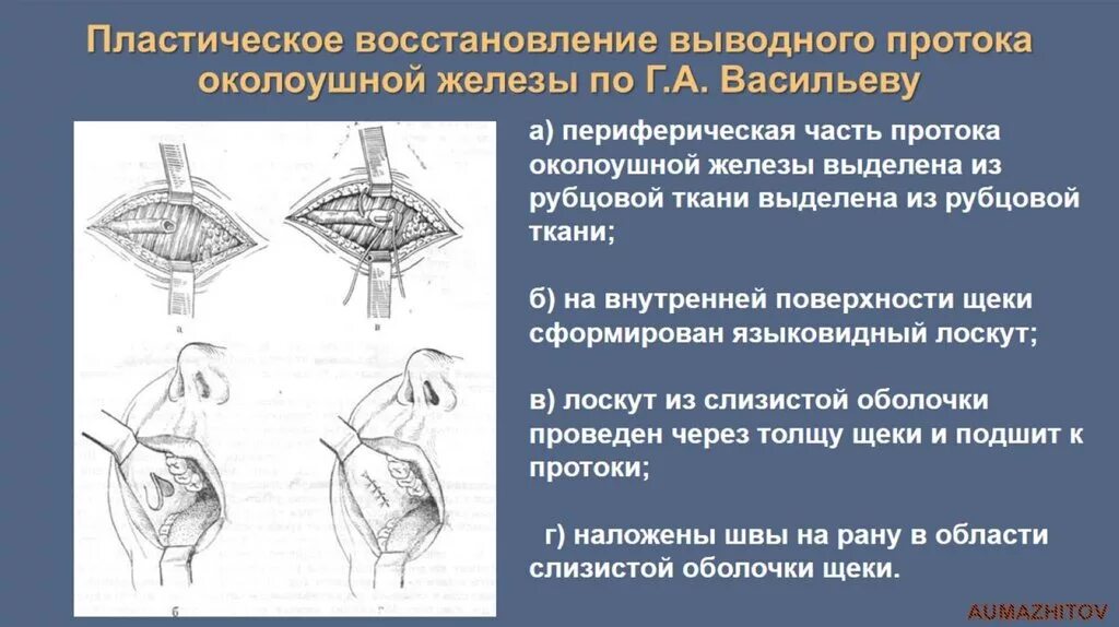 Операция на слюнной железе. Операции на околоушной слюнной железе. Резекция околоушной железы. Экстирпация слюнной железы. Операции околоушная железа