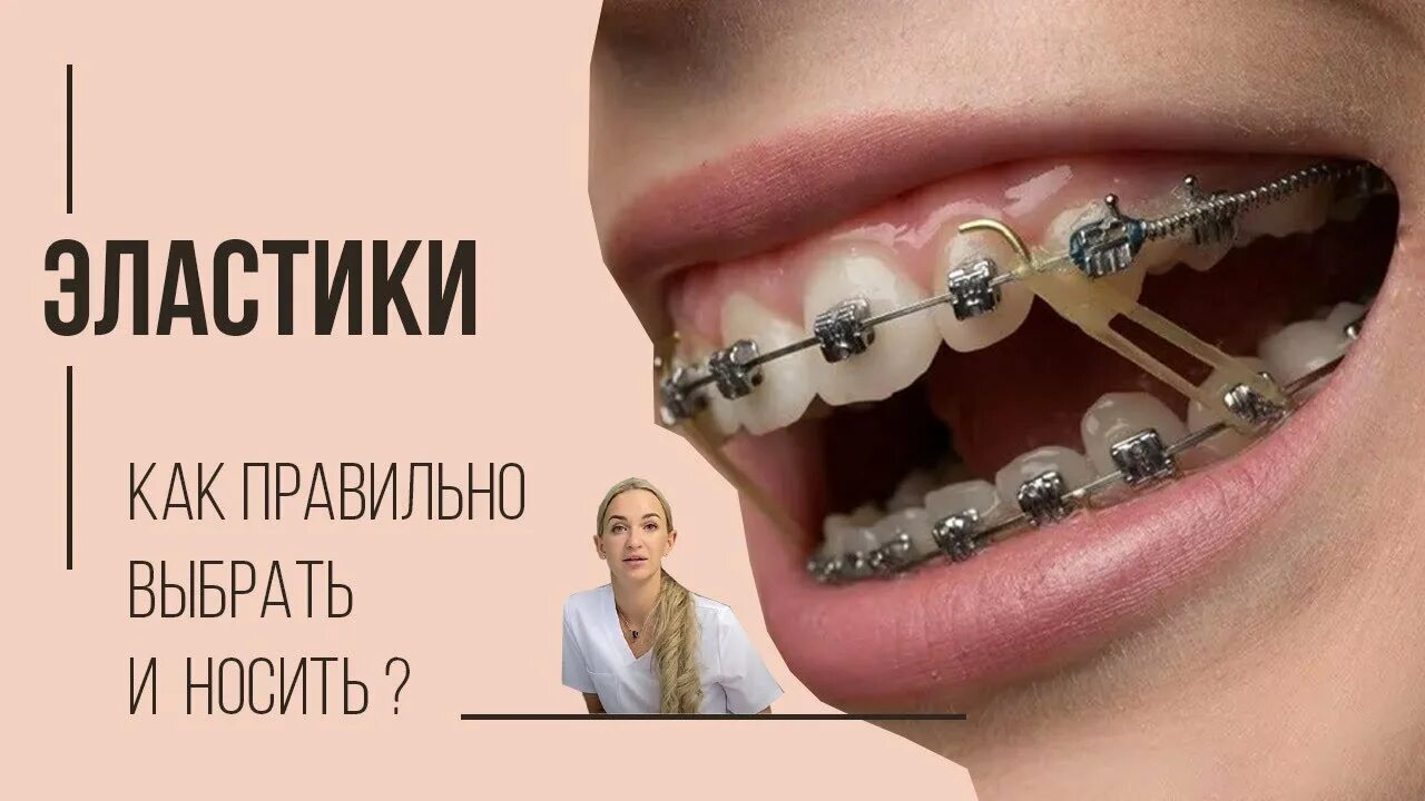 Сколько носить то. Брекеты межчелюстные эластики. Межчелюстные эластические тяги. Межчелюстные тяги ортодонтия.