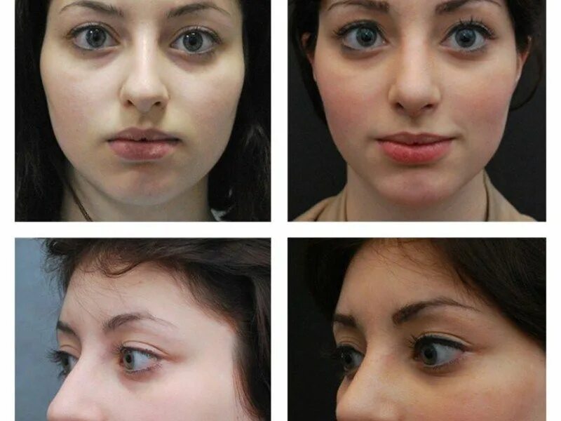 Аугментационная ринопластика. Абрамян соломон ринопластика. Пластика краснодар отзывы. Шемонаева ринопластика. Иса абдулазизович ринопластика.