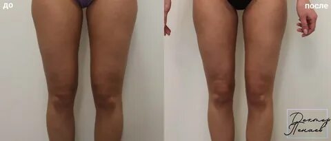Липосакция ног до и после