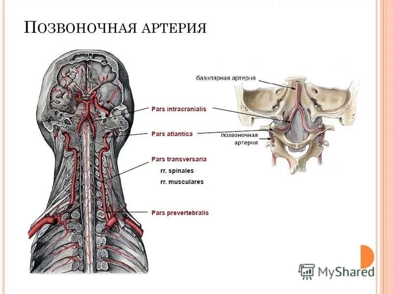 кт ангиография сонных артерий. окклюзия базилярной артерии неврология. гипоплазия v4 позвоночной артерии. гипоплазия v4 сегмента правой позвоночной артерии. суженная позвоночная артерия.