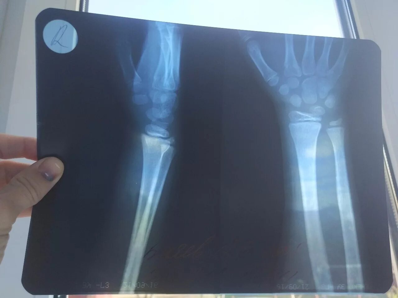 Рентгеновский снимок руки. Рентгеновский снимок перелома руки.