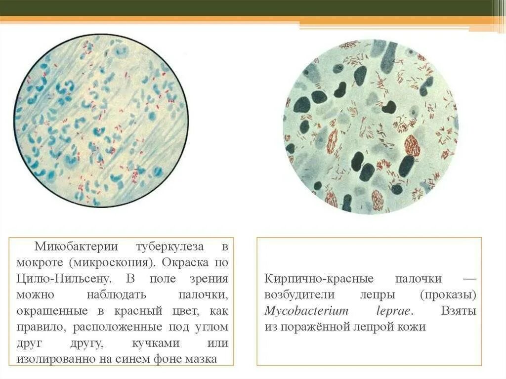 Микобактерии туберкулеза в мокроте окраска по Цилю Нильсену. Микобактерии туберкулеза микроскопия по Цилю Нильсену. Окраска мокроты по Цилю-Нильсену. Окраска Циль-Нильсену мокрота.