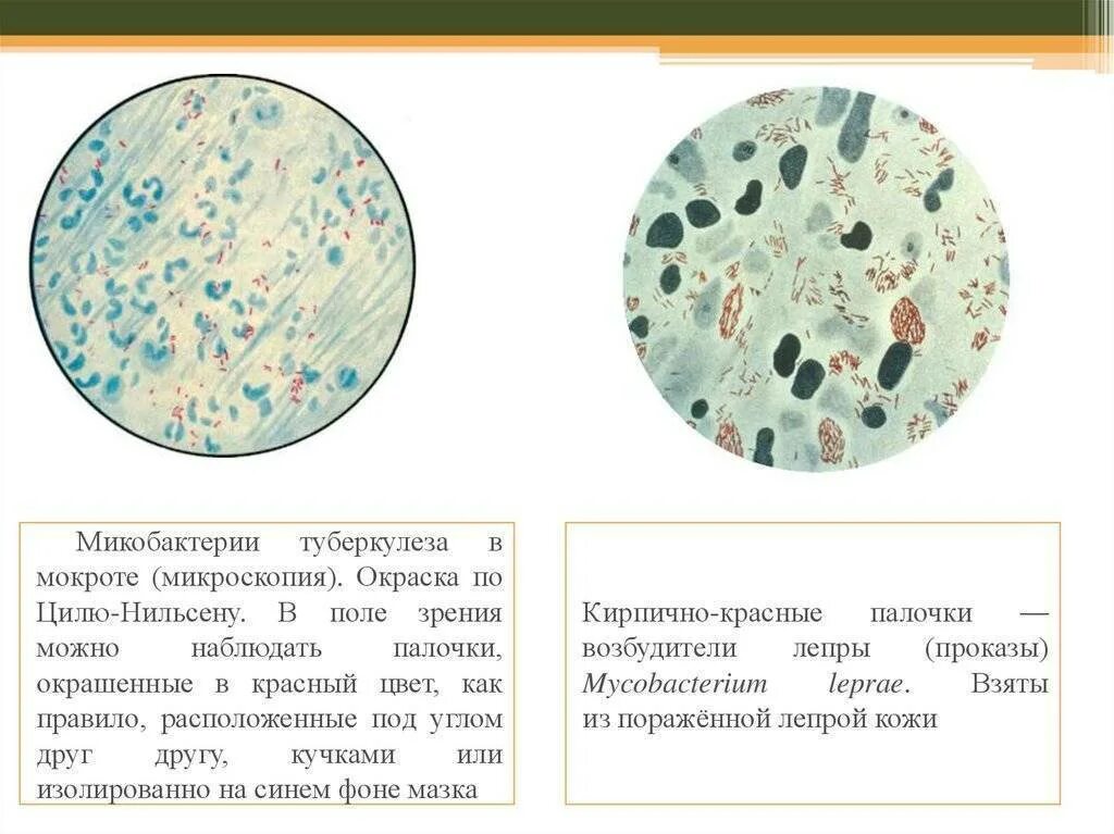 В мокроте можно обнаружить. Микобактерии туберкулеза в мокроте окраска по Цилю Нильсену. Микобактерии туберкулеза микроскопия по Цилю Нильсену. Окраска мокроты по Цилю-Нильсену. Окраска Циль-Нильсену мокрота.