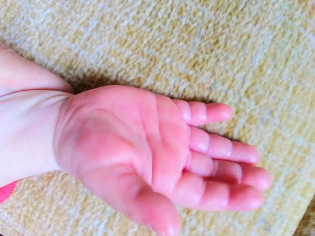 Красные запястья у ребенка. Покраснения на ладошках у ребенка. Цмпки на руках у ребенка. Красные запястья у ребенка. Аллергические прыщи на руках у ребенка.