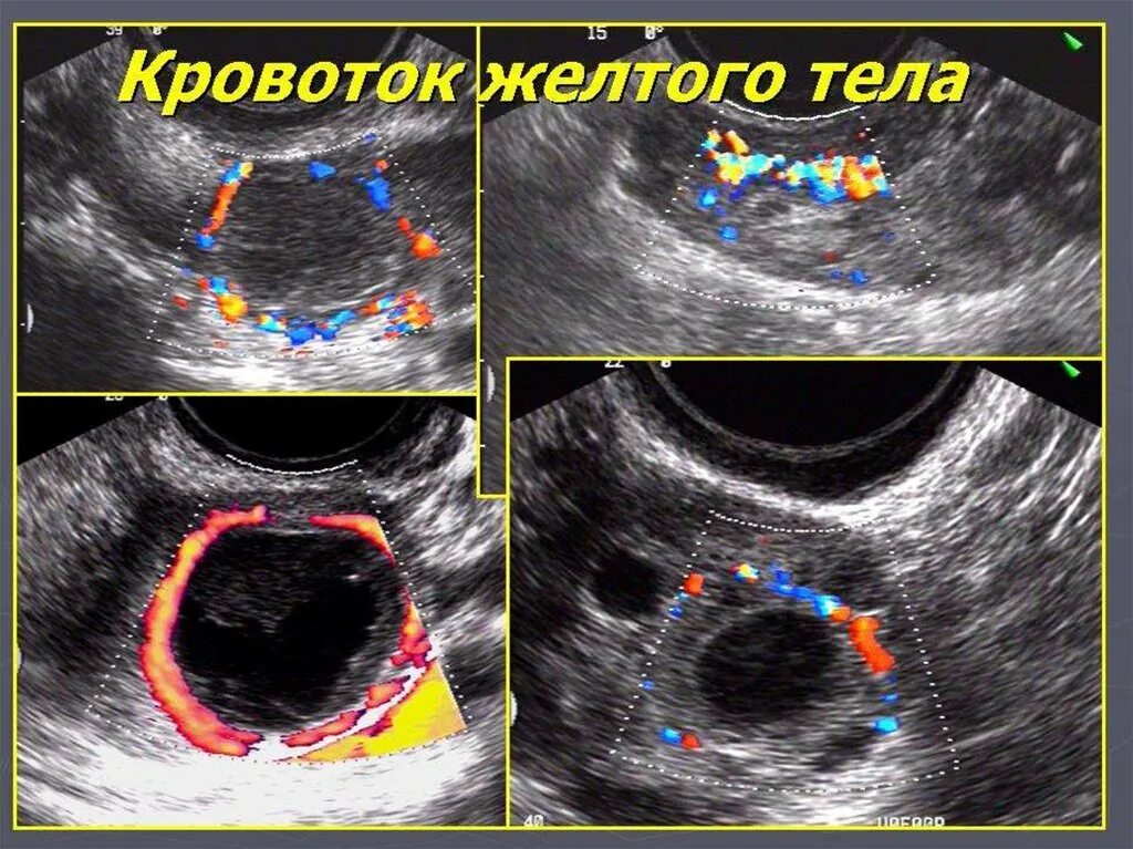 Желтое тело какие размеры. Желтое тело УЗИ картина.