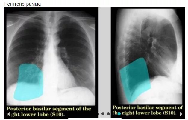 S 10 сегмент легких. S10 легкие сегмент. Сегменты левого легкого рентген. 7 Сегмент правого легкого. Образование левой доли легкого