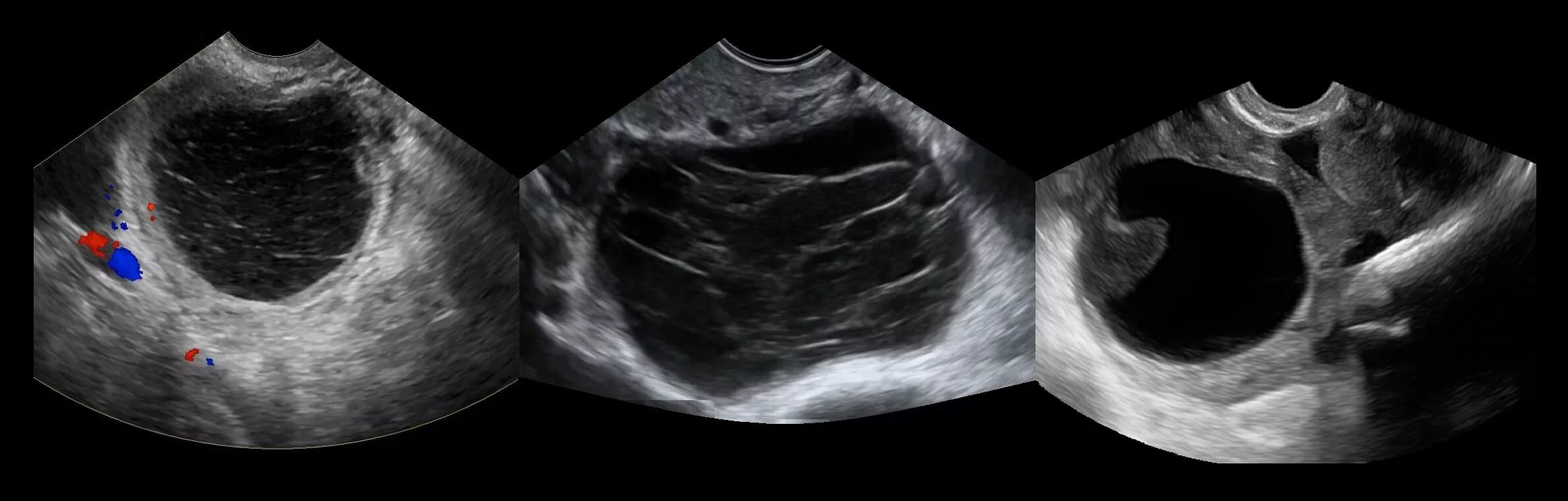 фолликулярная киста яичника на узи. геморрагическая киста яичника на узи. регресс кисты. регресс кисты. регресс кисты.