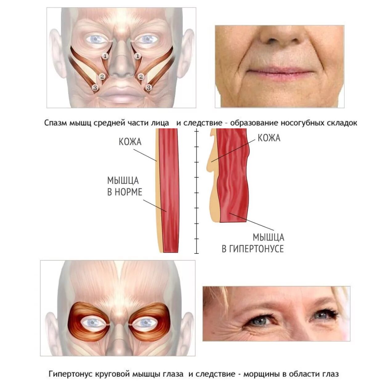 Почему образовываются складки. Гипертонус мимических мышц. Гипертонус скуловых мышц. Мышцы лица и морщины.