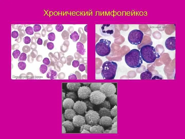 Волосатоклеточный лейкоз кровь. Волосатоклеточный лейкоз мазок. Волосатоклеточный лейкоз микропрепарат. Волосатоклеточный лейкоз гистология. Лимфолейкоз у взрослых