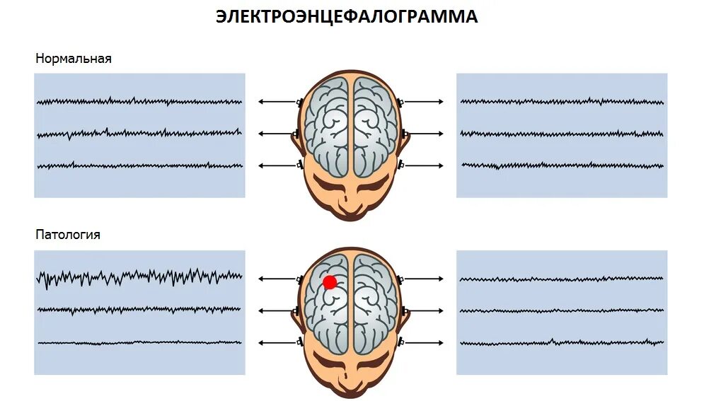 Электроэнцефалограмма головного мозга нормы показателей. ЭЭГ норма и патология. ЭЭГ головного мозга норма и патология. ЭЭГ В норме и при патологии.