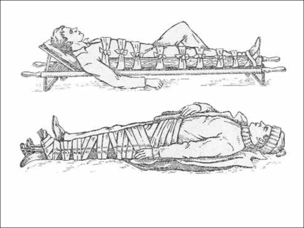 Перелом голени транспортировка. Транспортная иммобилизация при переломе бедренной кости. Иммобилизация при переломе бедренной кости. Иммобилизация при переломе бедра. Иммобилизация пострадавшего при переломе бедра.