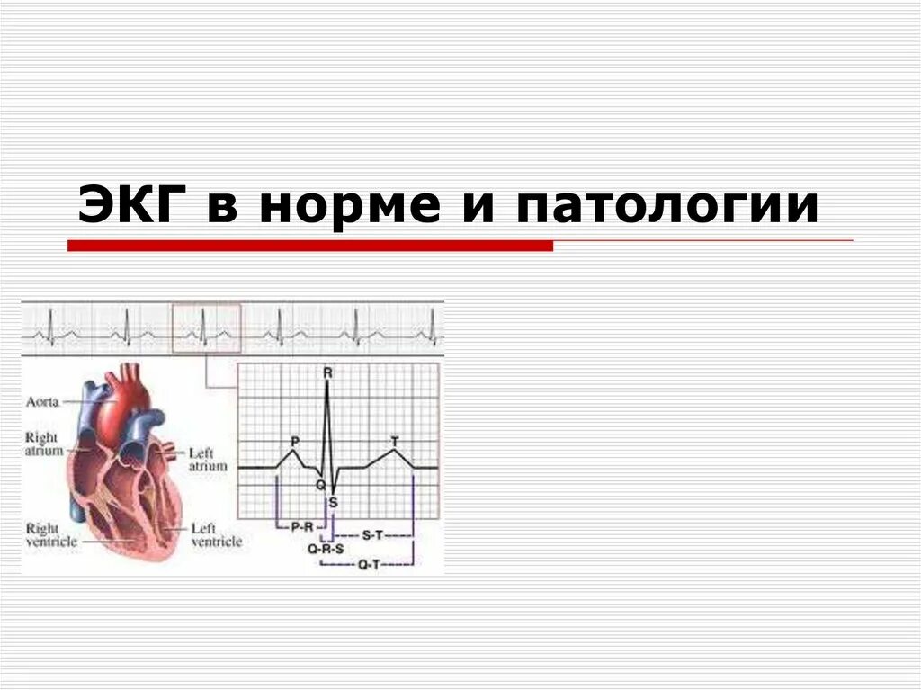 Кардиограмма норма. Экг сердца расшифровка патология. кардиограммы сердца норма и патология. экг расшифровка у взрослых норма и патология. показатели экг в норме и при патологии.