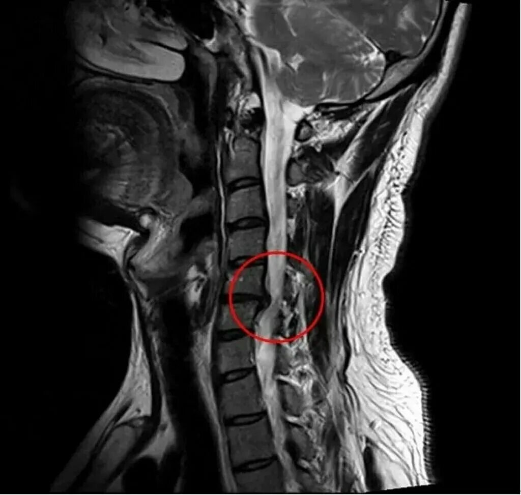 Спинальный стеноз операция. Междисковые грыжи шейного отдела. С5-с6 с6-с7 шейного отдела позвоночника. Грыжа шейных позвонков с3 с4. Мрт шеи позвонки с5.